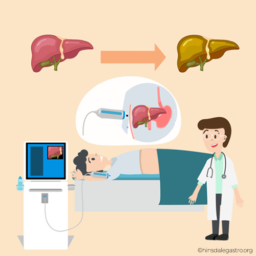Fibroscan
